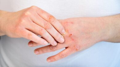Egzema (Atopik Dermatit) Nedir? Belirtileri Ve Tedavi Yöntemi